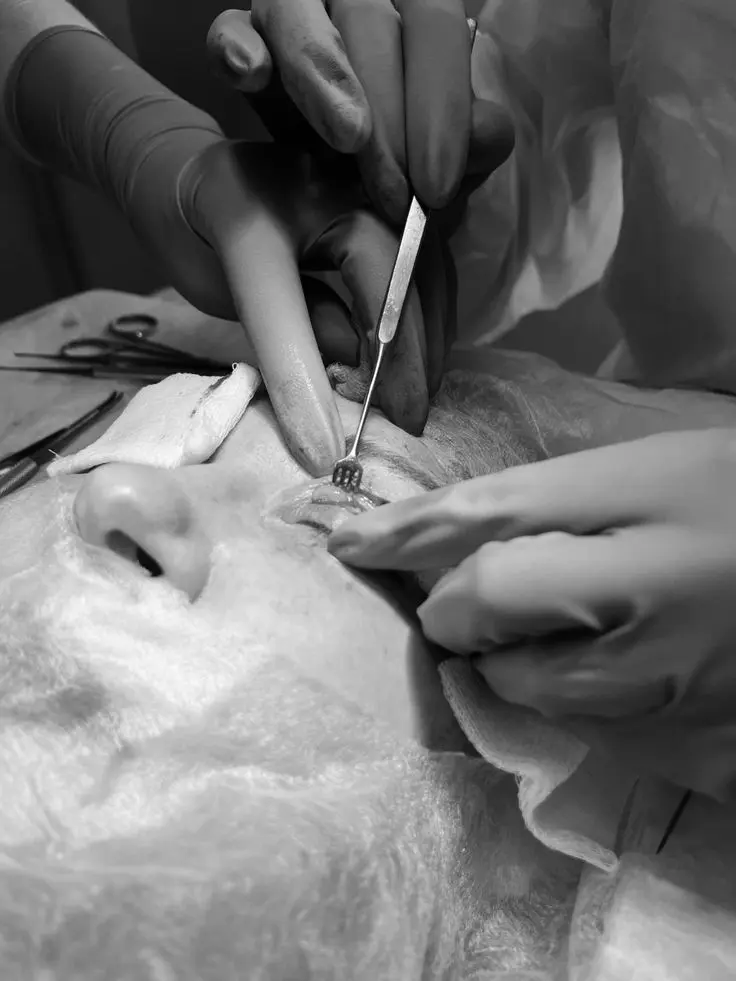 Blepharoplasty