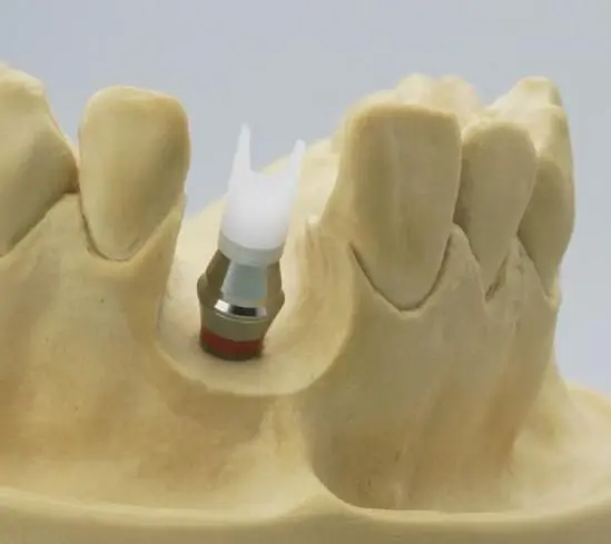 Индивидуальный абатмент