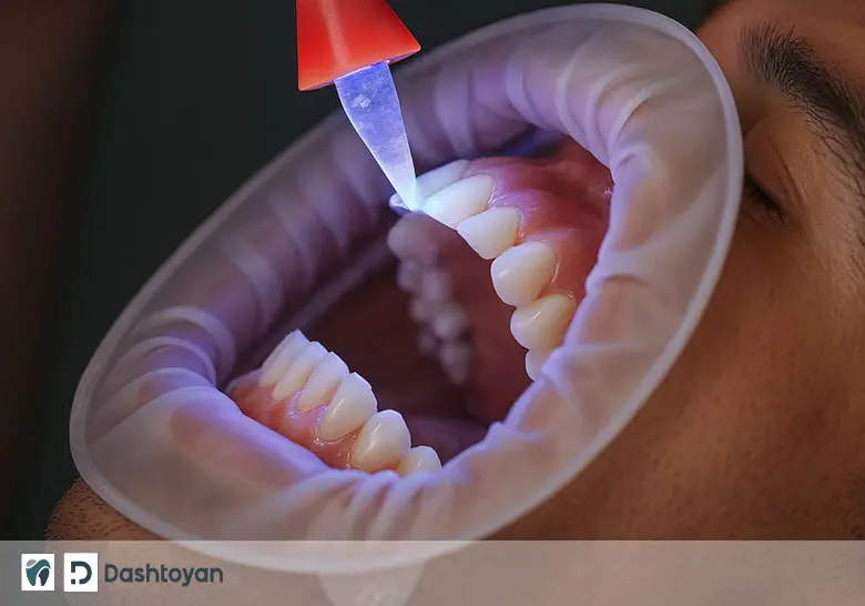 Композитная реставрация зубов