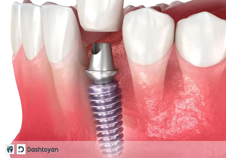 Имплантация