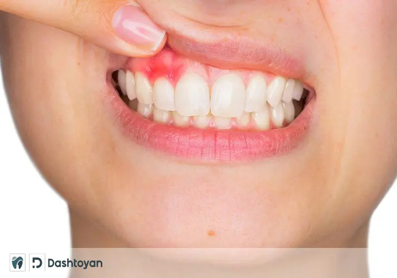 Dental Composite Restoration